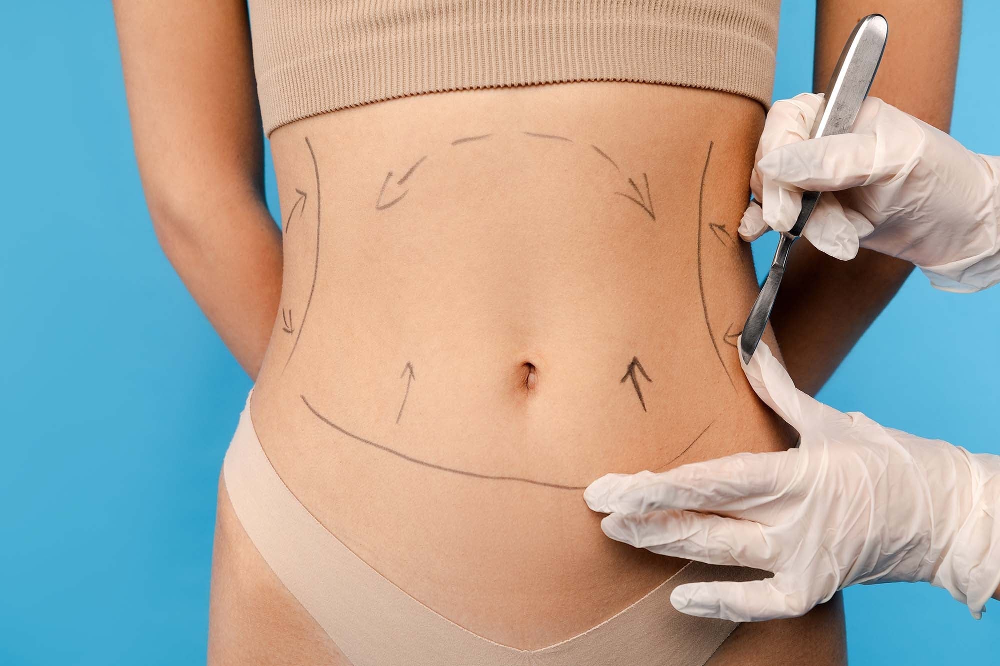 Liposuction Consultation